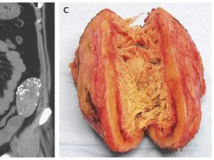 Penampakan Spons Operasi yang Tertinggal Bertahun-tahun di Tubuh Pasien
