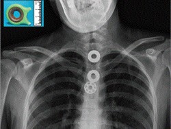 Foto Rontgen Ini Tunjukkan yang Terjadi Bila Menelan Fidget Spinner