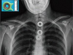 Foto Rontgen Ini Tunjukkan yang Terjadi Bila Menelan Fidget Spinner Foto Rontgen Ini Tunjukkan yang Terjadi Bila Menelan Fidget Spinner