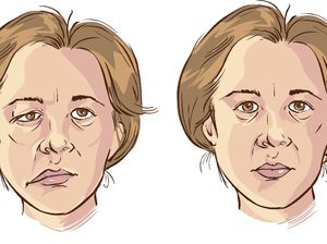 Bells Palsy, Apa Penyebab dan Bagaimana Cara Mengobatinya? Bells Palsy, Apa Penyebab dan Bagaimana Cara Mengobatinya?