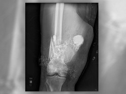 Ketika Dokter Angkat Petasan yang Bisa Meledak dari Kaki Pasien