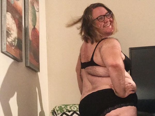 Gangguan Hormon, Wanita Ini Tetap Pede dengan Tubuh Penuh Bulu