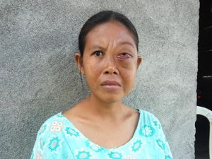 Tak Ada Biaya, Yuliastri Sudah 4 Tahun Hidup dengan Kanker Mata Tak Ada Biaya, Yuliastri Sudah 4 Tahun Hidup dengan Kanker Mata
