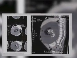 Ada Benjolan Mencurigakan, Bayi Ini Mengandung Kembarannya Sendiri