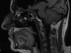 Pria Ini Sering Jatuh, Ternyata Sebagian Otaknya Lenyap