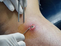 7 Cara Mengobati Bisul dengan Bahan Alami, Dijamin Kempes!