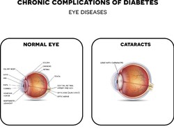 Capai 4 Persen, Jumlah Penderita Katarak di Lamongan Samai Nasional