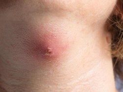 Penyebab Bisul, Gejala, hingga Cara Mengobatinya