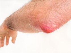 7 Pengobatan Alami agar Bisul Cepat Kempes dan Tidak Sakit