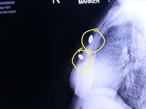 Ini Dugaan Jenis Senjata Digunakan Pria Bertopeng Tembak Atikah