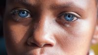 Aww.. Mata Biru Menyala Penyandang Sindrom Waardenburg