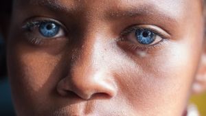 Aww.. Mata Biru Menyala Penyandang Sindrom Waardenburg