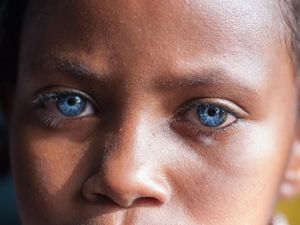 Aww.. Mata Biru Menyala Penyandang Sindrom Waardenburg