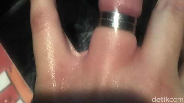 Foto: Jari Manis Mahasiswi Bandung yang Dipaksa Pakai Cincin