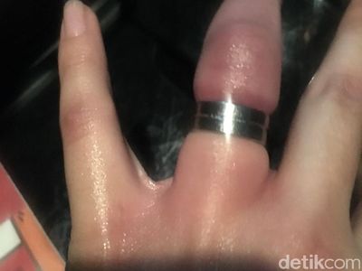 Foto: Jari Manis Mahasiswi Bandung yang Dipaksa Pakai Cincin