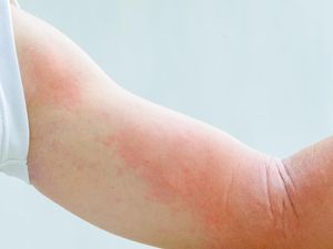 Video: Mengenal Jenis Alergi Kulit, Biduran Hingga Stevens Johnson Syndrome Video: Mengenal Jenis Alergi Kulit, Biduran Hingga Stevens Johnson Syndrome