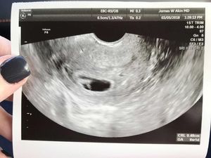 Mulanya Dinyatakan Infertil, Tapi Akhirnya Perempuan Ini Hamil Mulanya Dinyatakan Infertil, Tapi Akhirnya Perempuan Ini Hamil