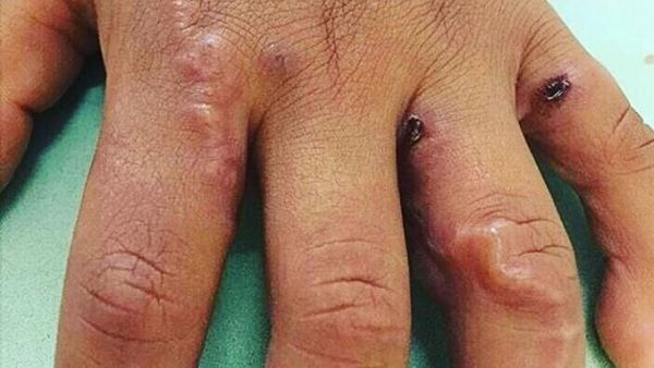 Pernah Temukan Luka Seperti Ini? Tanda Ada Cacing Parasit di Kulit