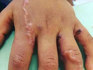 Pernah Temukan Luka Seperti Ini? Tanda Ada Cacing Parasit di Kulit