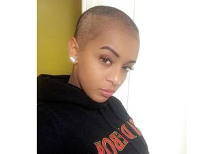 Wanita 25 Tahun Alami Kebotakan Dini karena Gaya Rambutnya