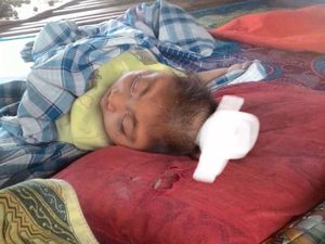 Tolong! Bayi Asal NTB Ini Otaknya Menyembul Keluar