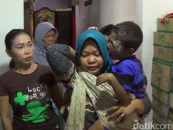 Menjenguk Bocah Penderita Kanker Kulit dan Tumor Mata di Batang