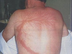 Foto: Penampakan Luka Khas Para Korban Sambaran Petir