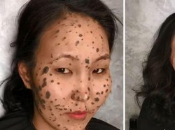 Lahir dengan Tahi Lalat Sewajah, Transformasi Wanita Ini Bikin Pangling