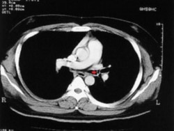 Batuk Selama 4 Bulan, Ternyata Tulang Rahang Tersangkut di Tenggorokan