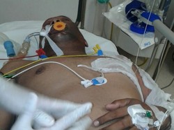 Operasi Kulit Petugas Damkar Berjalan Baik, Pulih 3 Bulan Lagi