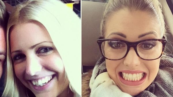 Transformasi Para Pemakai Kawat Gigi, Senyum Jadi Lebih Menarik