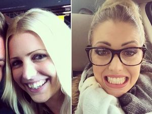 Transformasi Para Pemakai Kawat Gigi, Senyum Jadi Lebih Menarik