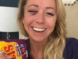 Rongga Mata Reporter TV Ini Retak Kena Bola Bisbol Saat Liputan