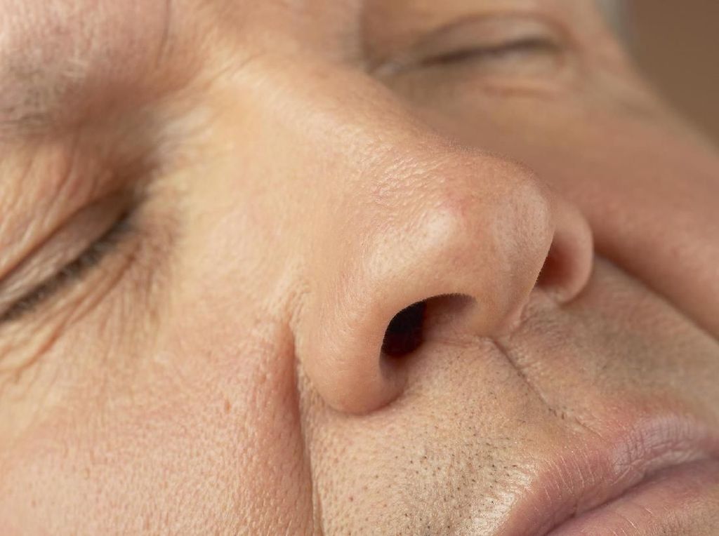 Mimisan 3 Bulan dan Ada Benjolan, Hidung Pria Ini Terinfeksi Parasit Mimisan 3 Bulan dan Ada Benjolan, Hidung Pria Ini Terinfeksi Parasit