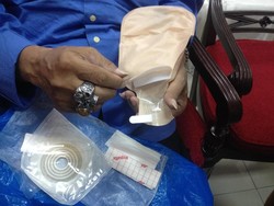 Susah Dapat Kantong Stoma, Pasien Kanker Sempat Gunakan Plastik Gula