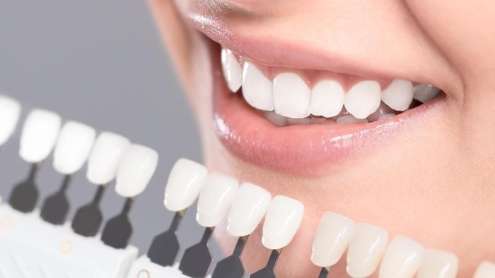 Veneer gigi merupakan tindakan medis yang harus dilakukan oleh dokter gigi profesional. (Foto: thinkstock)