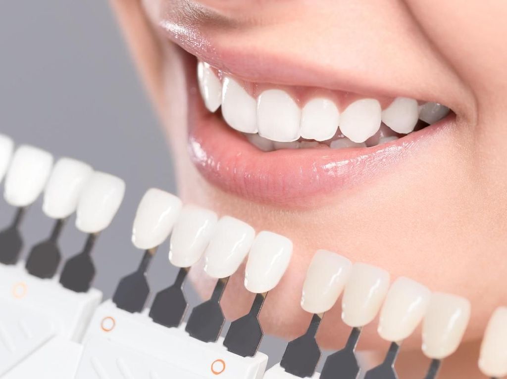 5 Dampak Bahaya Pemasangan Veneer Gigi yang Sembarangan