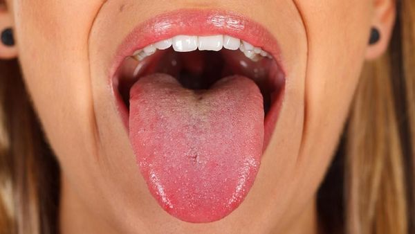 Menebak Kondisi Kesehatan Seseorang Lewat Lidah