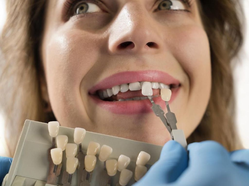 Pasang Veneer Gigi Murah Tak Sebanding dengan Risiko Gagalnya Pasang Veneer Gigi Murah Tak Sebanding dengan Risiko Gagalnya
