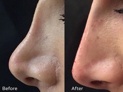 Faktor Penyebab Hidung Pesek dan Tips Agar Terlihat Mancung