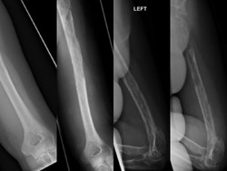 Tulangnya Menghilang, Wanita Ini Didiagnosis Penyakit Gorham-Stout