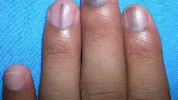 9 Contoh Tanda Penyakit yang Bisa Muncul di Kuku