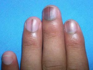 9 Contoh Tanda Penyakit yang Bisa Muncul di Kuku