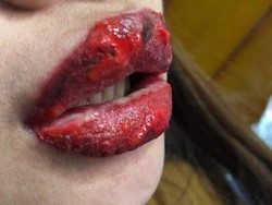 Ingin Punya Bibir Pink Merona, Bibir Wanita Ini Malah Jadi Bernanah & Koreng