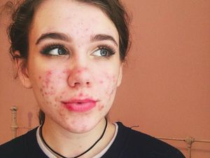 Gara-gara Obat Jerawat, Mata Remaja Ini Nyaris Buta