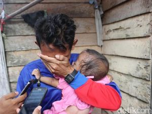 Dinkes Riau Bantah Balita Natania Alami Gizi Buruk, tapi...