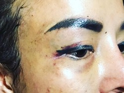 Unggah Foto Babak Belur, Cynthiara Alona Kenapa?