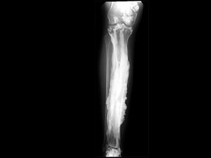 Menguak Penyakit yang Membuat Tulang Orang Meleleh Seperti Lilin