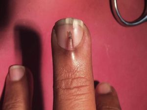 Penampakan Kasus Langka Ada Kuku Ekstra Tumbuh di Jari Tengah Penampakan Kasus Langka Ada Kuku Ekstra Tumbuh di Jari Tengah