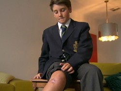 Australia Kewalahan Hadapi Serangan Bakteri Pemakan Daging